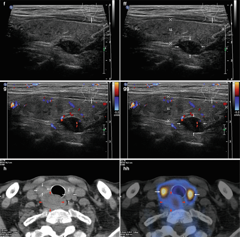 Parathyroid Gland On Ultrasound 4558