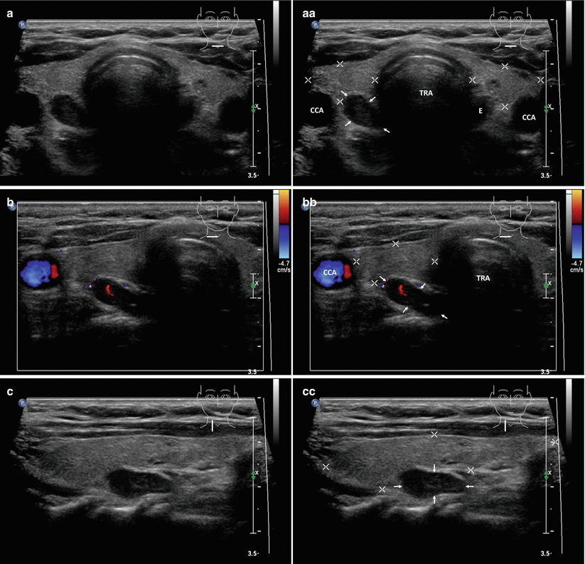 Parathyroid Adenoma and Parathyroid Carcinoma | Radiology Key