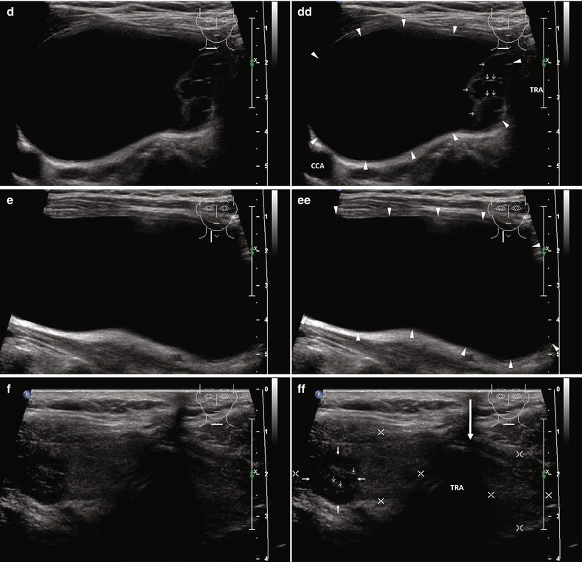 Percutaneous Ethanol Injection Therapy | Radiology Key