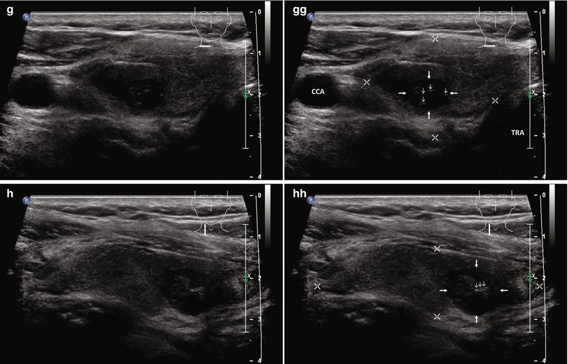 Percutaneous Ethanol Injection Therapy | Radiology Key