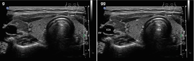 ultrasound-guided-fine-needle-aspiration-biopsy-us-fnab-radiology-key