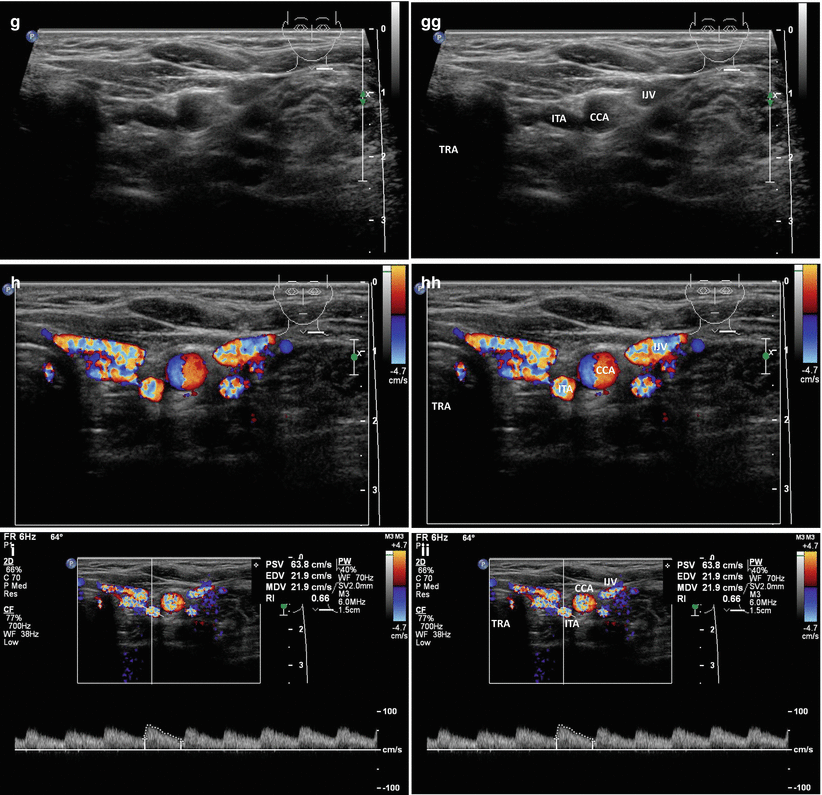 Hashimotos Ultrasound 2084