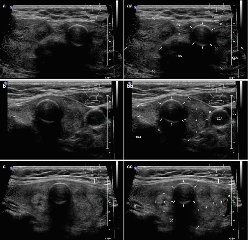 Complex Nodule | Radiology Key