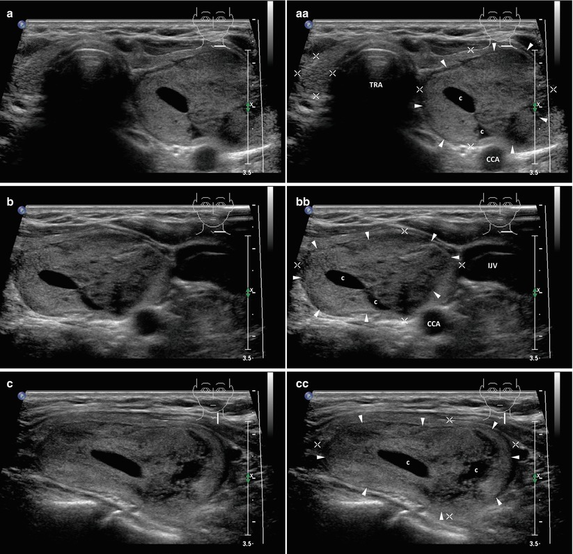 Complex Nodule | Radiology Key