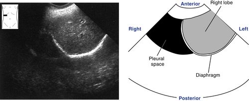 caudate lobe of liver ultrasound