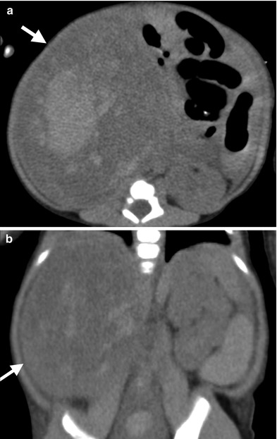 Adrenal Gland Radiology Key 8679