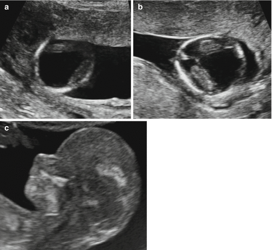 First Trimester Pathologies Radiology Key 