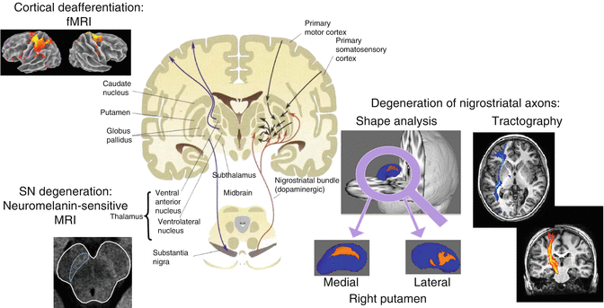 High-Field Neuroimaging in Parkinson’s Disease | Radiology Key