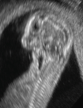 Evaluation Of The Fetal Face In The First Trimester | Radiology Key