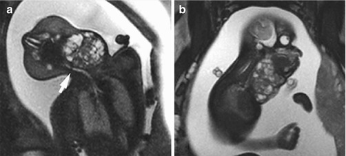 Magnetic Resonance Imaging Mri In The Evaluation Of The Fetal Face