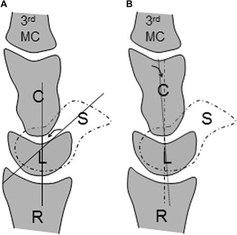 Pitfalls of Wrist MR Imaging | Radiology Key