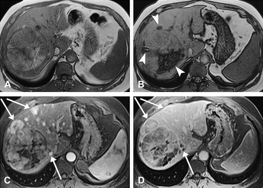 Tumors of the Liver and Intrahepatic Bile Ducts: Radiologic–Pathologic ...