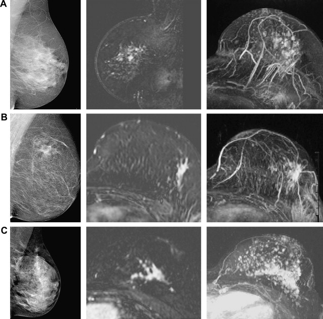 Invasive Lobular Carcinoma Mammogram 