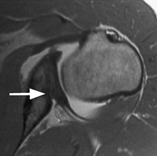 Shoulder MR Imaging Normal Variants and Imaging Artifacts | Radiology Key