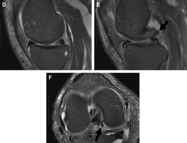 Magnetic Resonance Imaging of Penile Cancer | Radiology Key