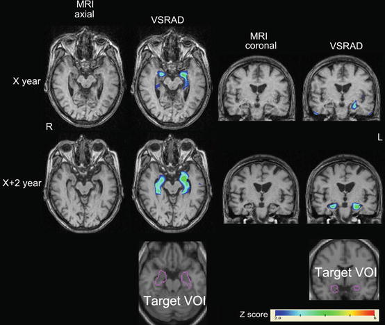 Structural Neuroimaging In Alzheimer’s Disease | Radiology Key