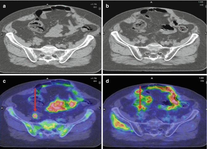 Role Of PET/CT In Radiotherapy Treatment Planning | Radiology Key