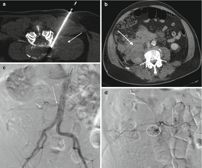 Anticoagulation Management | Radiology Key