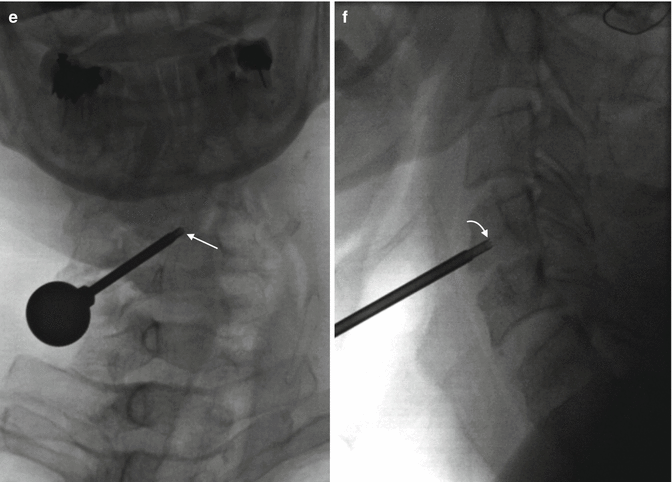 Cervical Spine Biopsy Radiology Key 