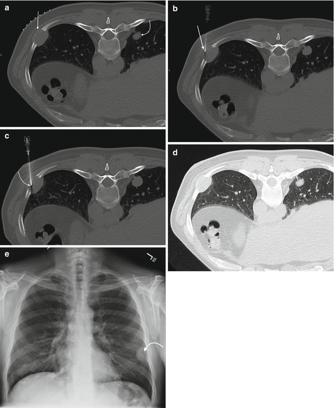Rib Biopsy Radiology Key