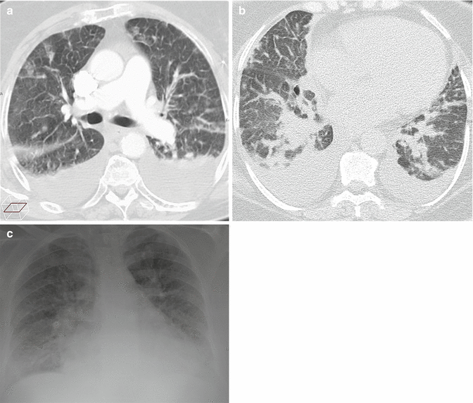 Lung Parenchyma Pneumonia