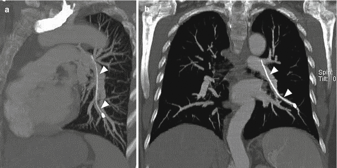 embolism-radiology-key