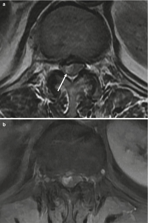 Top 3 Spinal Tumors of Each Compartment | Radiology Key