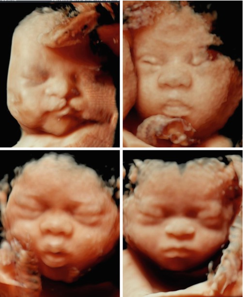 Normal Face | Radiology Key