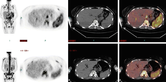 18F-FDG PET/CT: Normal Variants, Artefacts and Pitfalls in Lymphoma ...