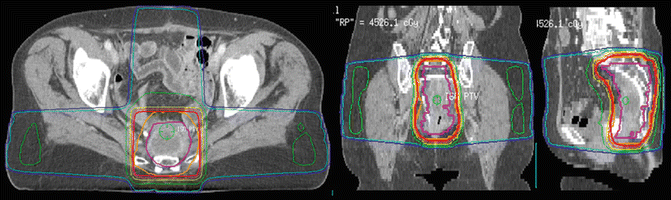 and Reirradiation | Radiology Key