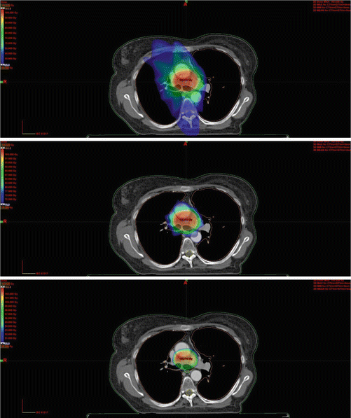 Cancer | Radiology Key