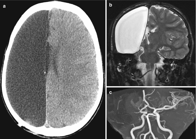 Imaging The Intraoperative And Postoperative Brain | Radiology Key