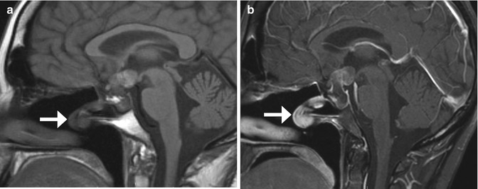 Imaging of the Postoperative Skull Base and Cerebellopontine Angle ...