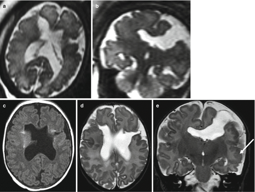 Malformations Of Cortical Development | Radiology Key