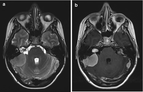 melanotic nerve sheath sarcoma symptoms UK Vet Companion Animal - A case of trigeminal peripheral nerve sheath  tumour in a dog diagnosed with tru-cut biopsy