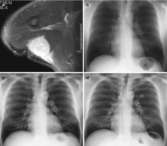 Follow Up Imaging Of Soft Tissue Tumors Radiology Key