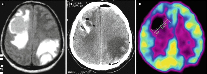 Lung Cancer (LC) | Radiology Key