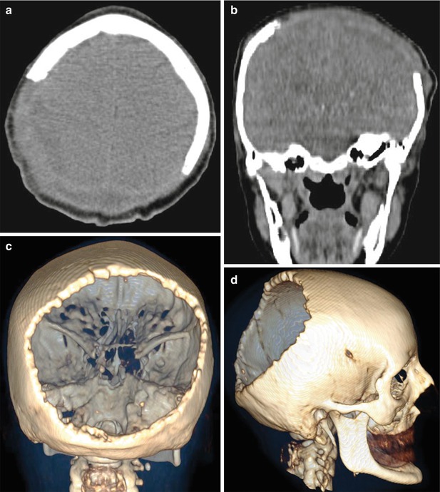 Melanoma | Radiology Key