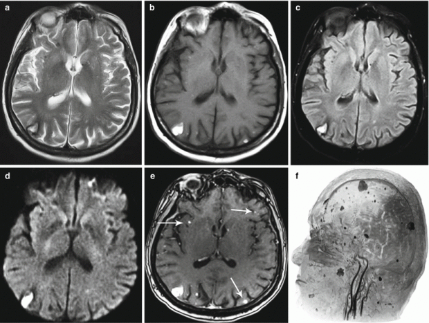 Testicular Cancer | Radiology Key