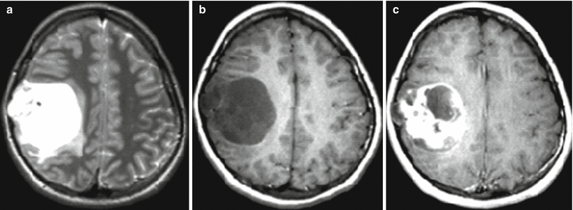 Oligodendroglioma (ODG) | Radiology Key