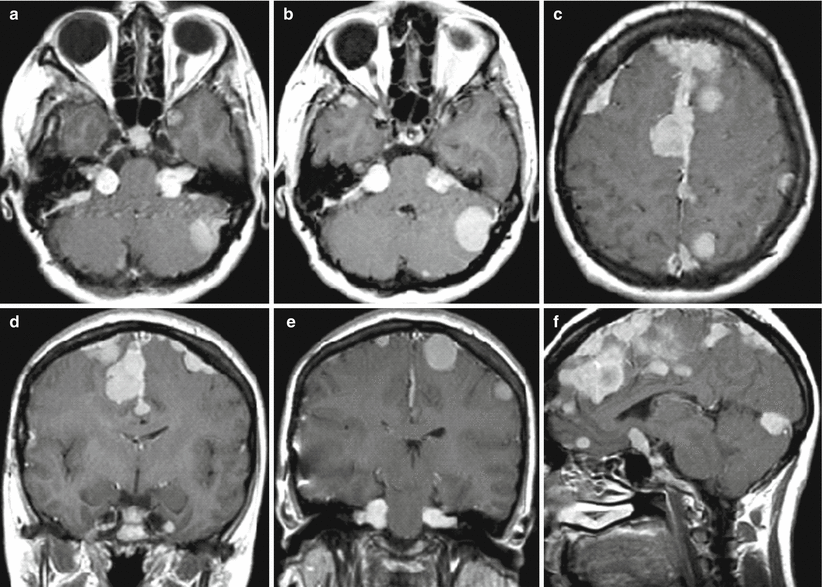 23 Incidental Meningioma Radiology Key | Hot Sex Picture