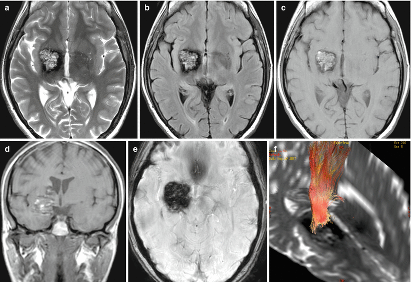 Cavernous Angiomas Cavernous Malformations Radiology Key