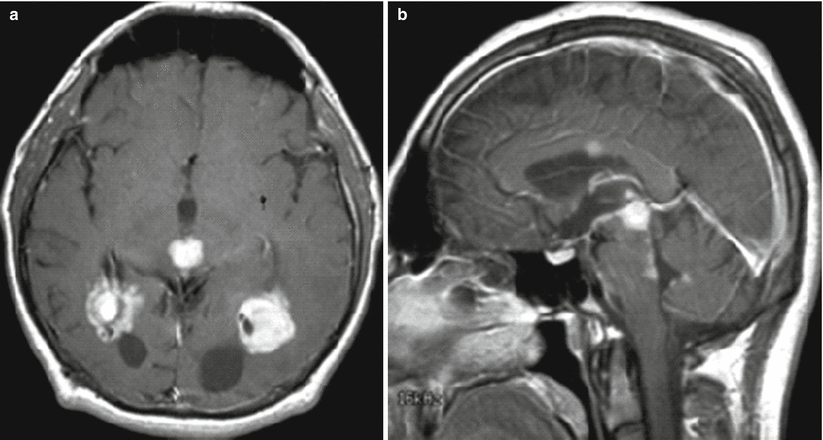 tumors-of-the-pineal-region-radiology-key