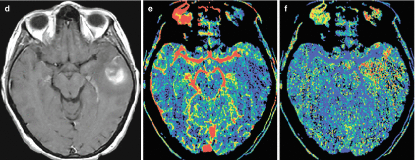 Intracranial Infection | Radiology Key
