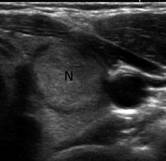 Feature Illustration: Echogenicity, Composition, and Shape | Radiology Key