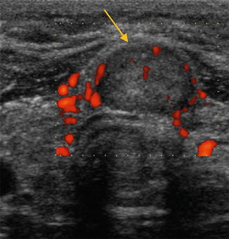 follicular thyroid cancer ultrasound