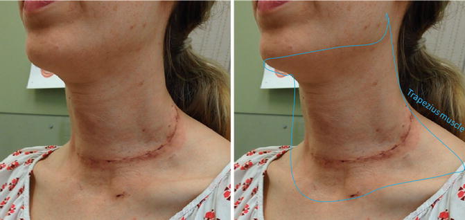 shotty lymph nodes after infection