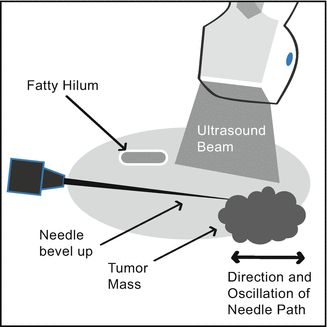 The Procedure of Ultrasound-Guided Percutaneous Biopsy of Thyroid and ...