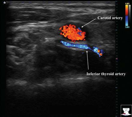 labeled thyroid ultrasound