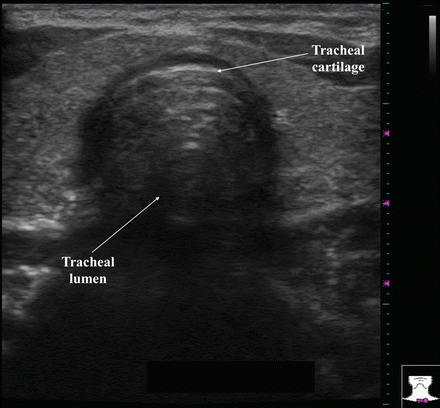 Normal Thyroid Appearance and Anatomic Landmarks in Neck Ultrasound ...